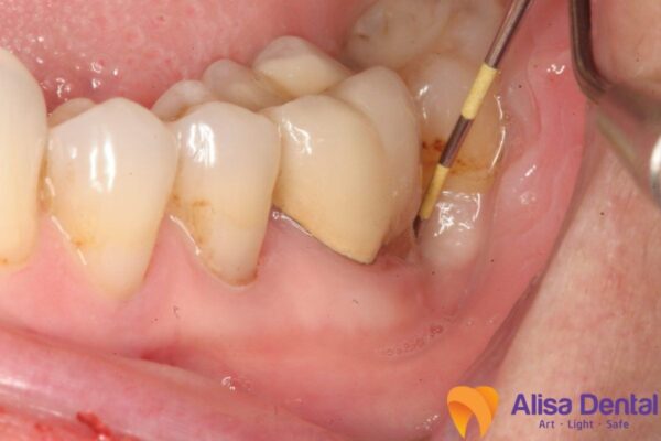 Biến chứng của sâu răng nặng 