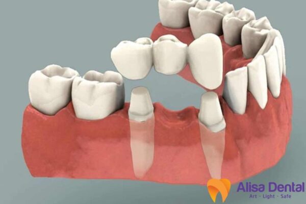 điều trị sâu răng nặng