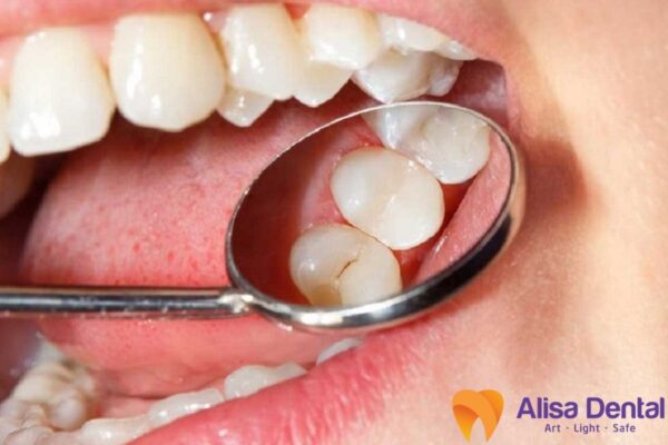 Nhận biết dấu hiệu sâu răng nặng