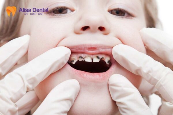 Nguyên nhân gây sâu răng cho trẻ em