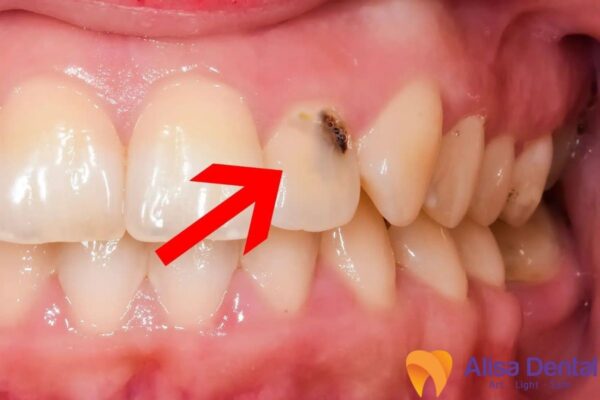 Dấu hiệu nhận biết sâu răng 