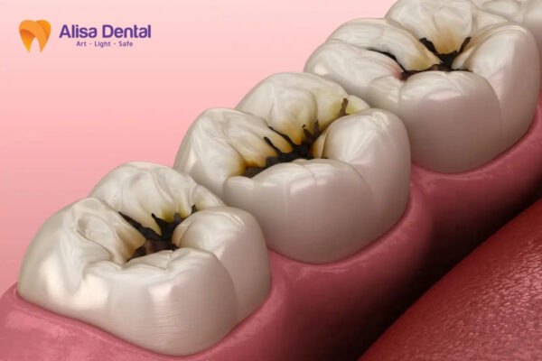 dấu hiệu sâu răng 