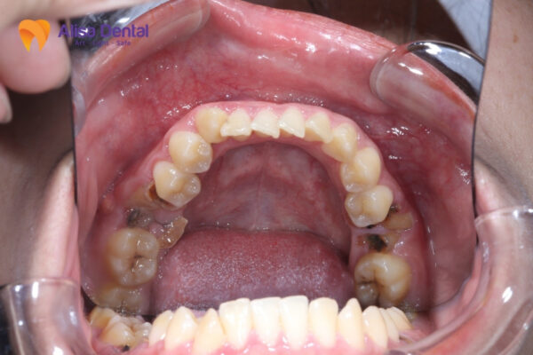 Chữa sâu răng số 7 