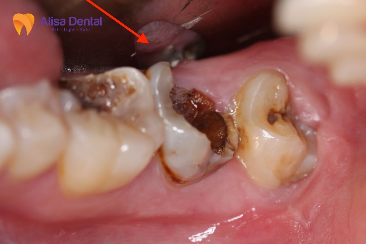 Phương pháp chữa sâu răng số 8