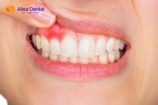 Viêm lợi sâu răng là gì