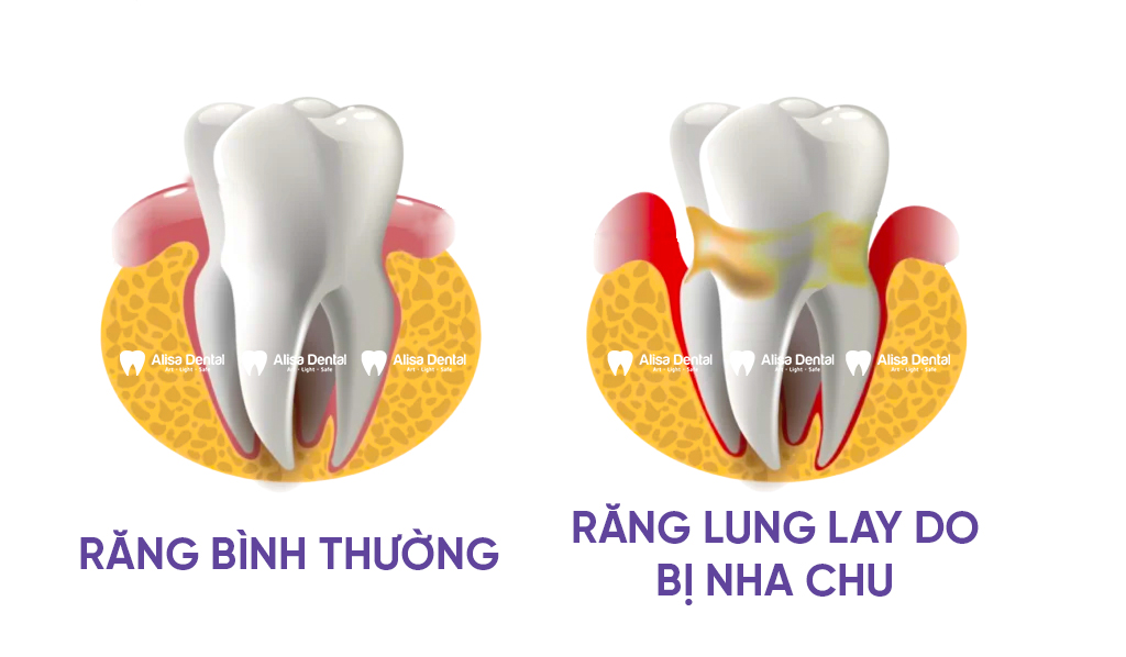 Lợi ích vượt trội khi điều trị bằng công nghệ tái sinh răng thật tại Alisa