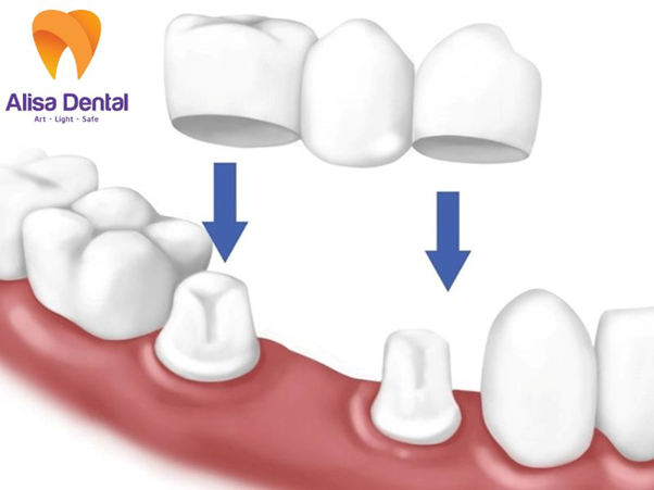 Thay vì cấy từng trụ, bác sĩ sẽ cấy trụ trước và gắn 1 cầu răng sứ lên trên