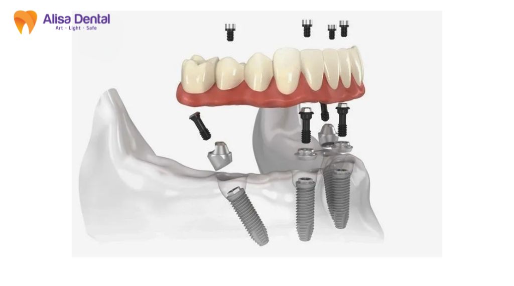 implant straumann là gì
