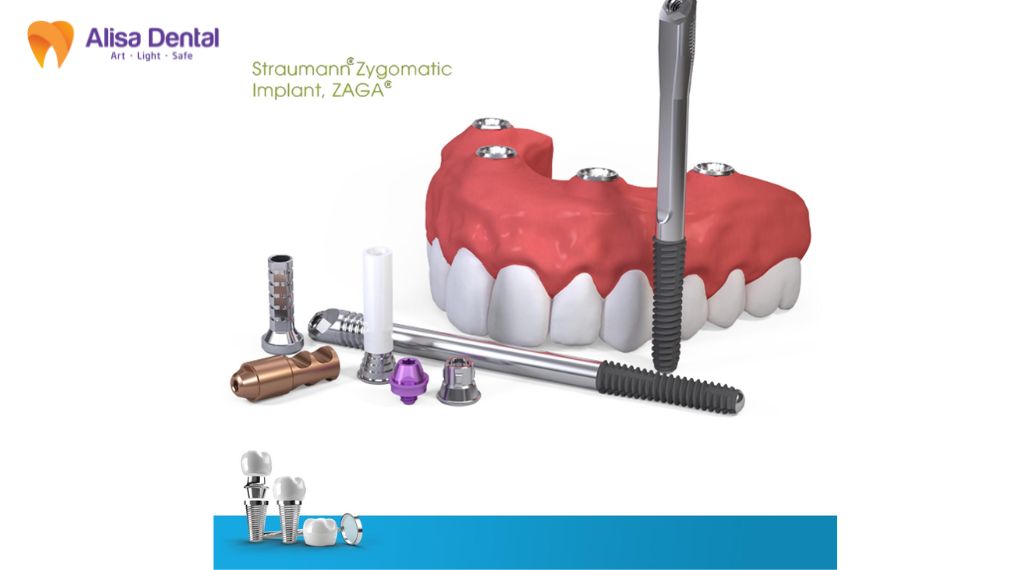 implant straumann là gì