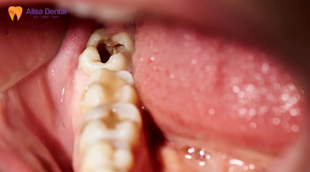 Khi nào nên nhổ răng khôn