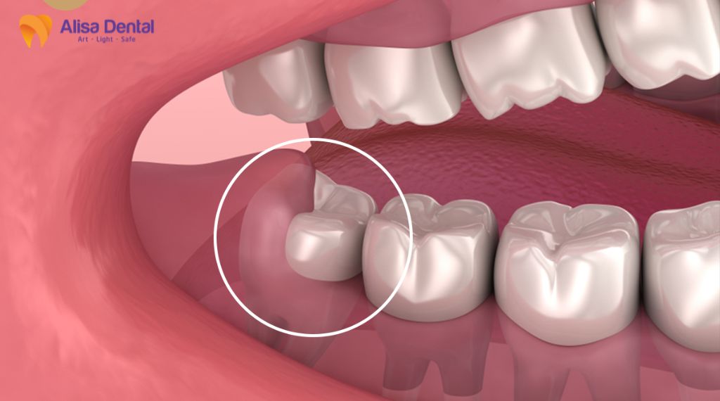 Khi nào nên nhổ răng khôn