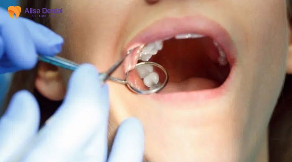 Khi nào nên nhổ răng khôn