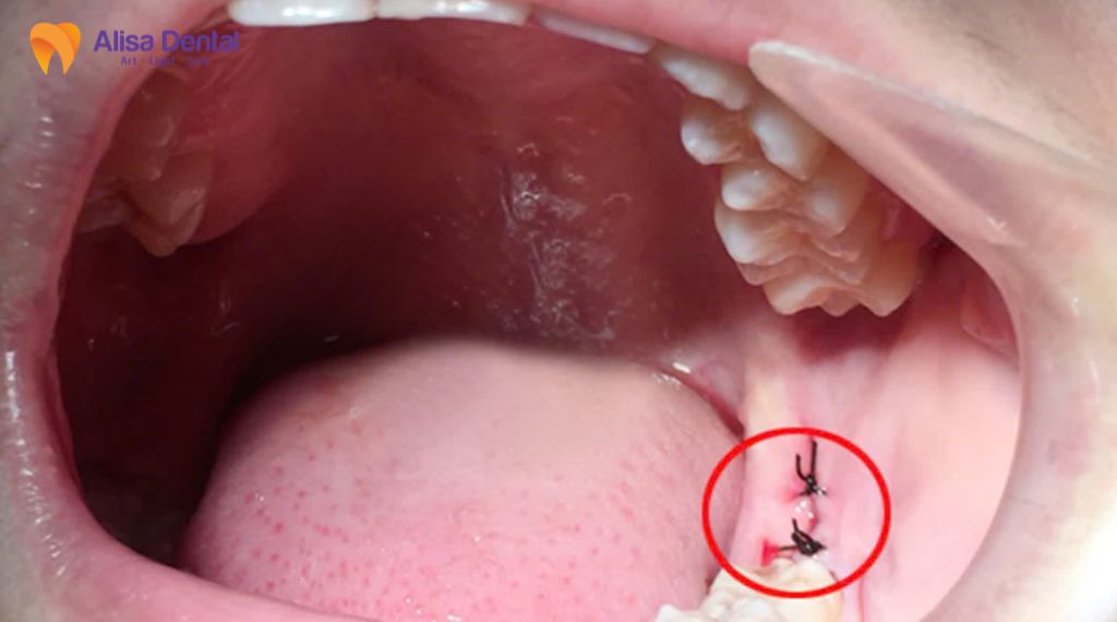 Nhổ răng khôn bao lâu thì lành