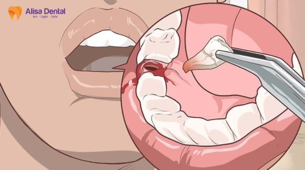 Nhổ răng khôn bao lâu thì lành