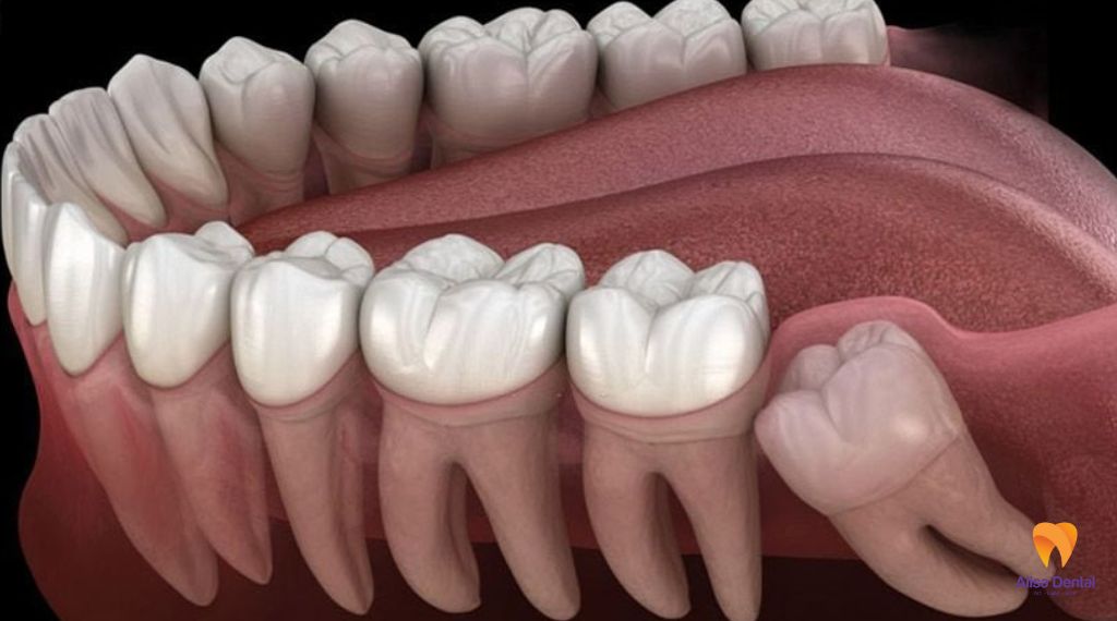 Nhổ răng khôn bao lâu thì lành