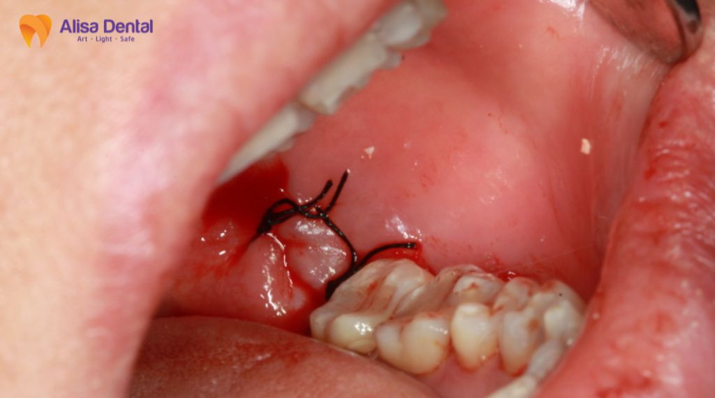 Nhổ răng khôn bao lâu thì lành