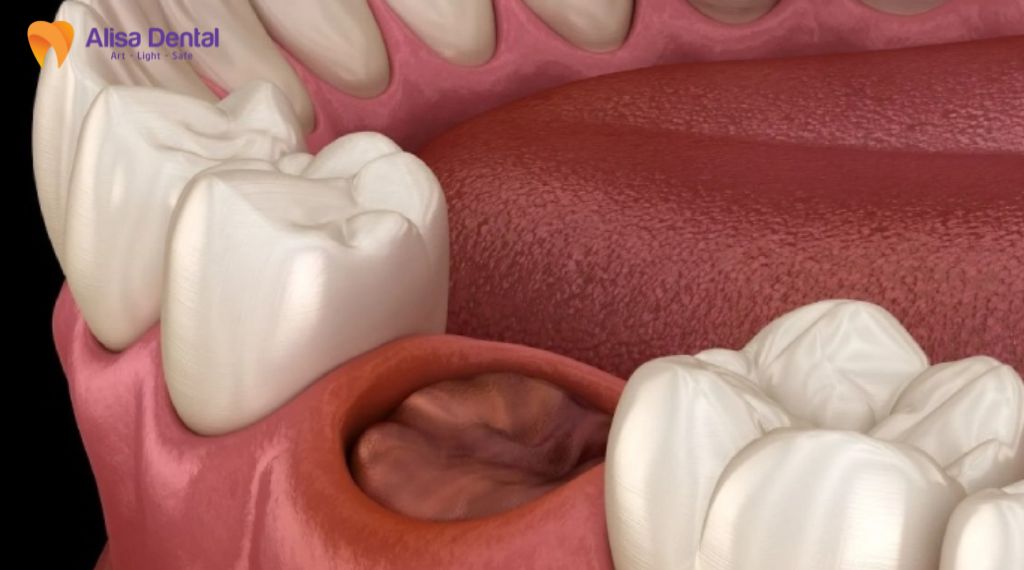 Nhổ răng khôn bao lâu thì lành