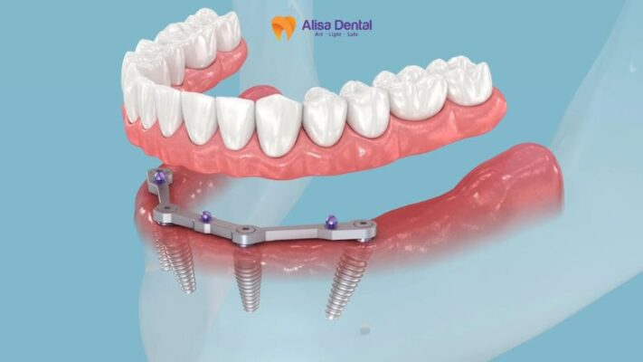 Tác dụng của cấy implant 