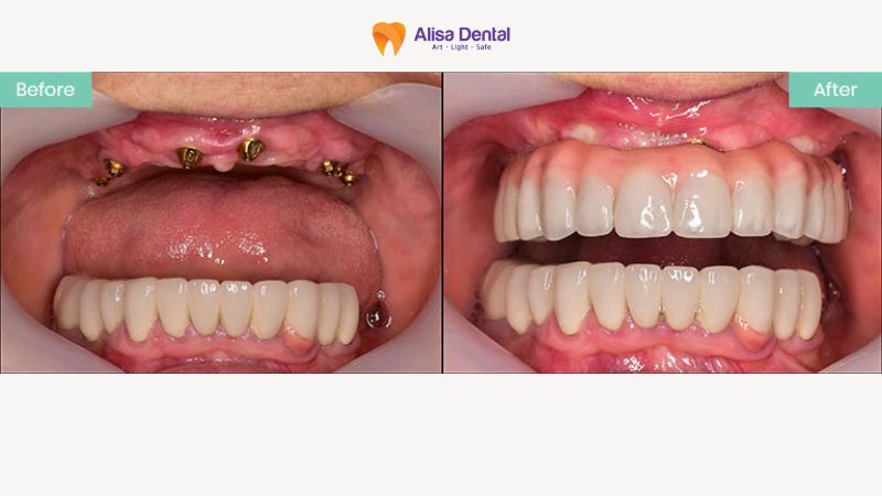 Quy trình kỹ thuật cấy implant 7 bước