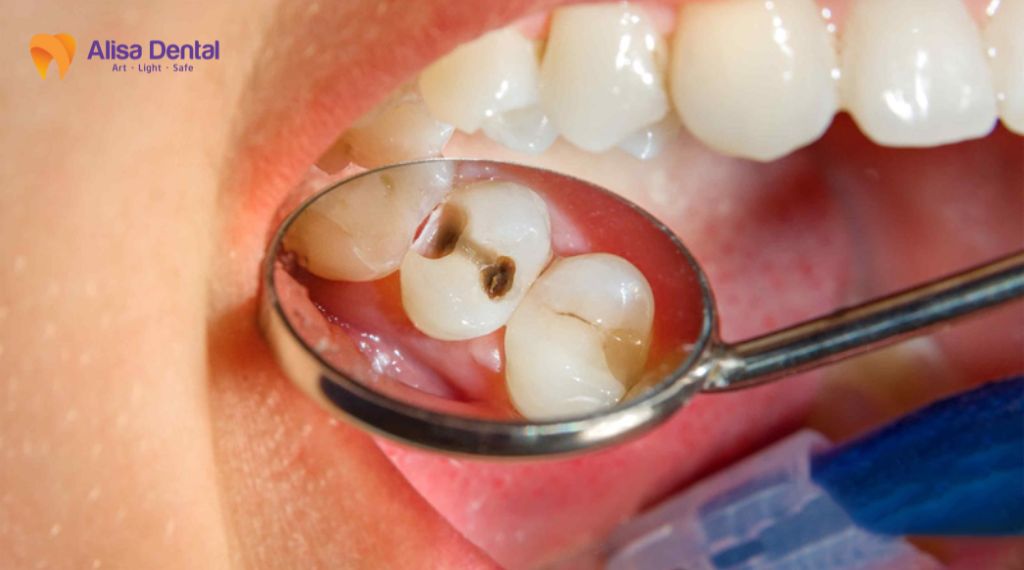 Điều trị tủy răng