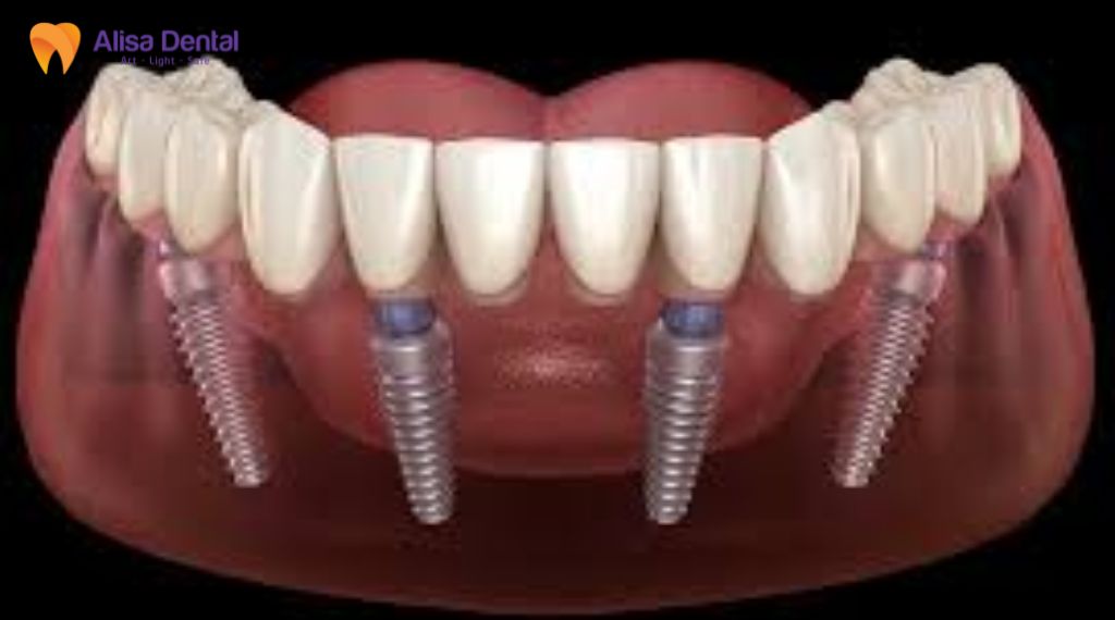 implant all on 4 Implant all on 6