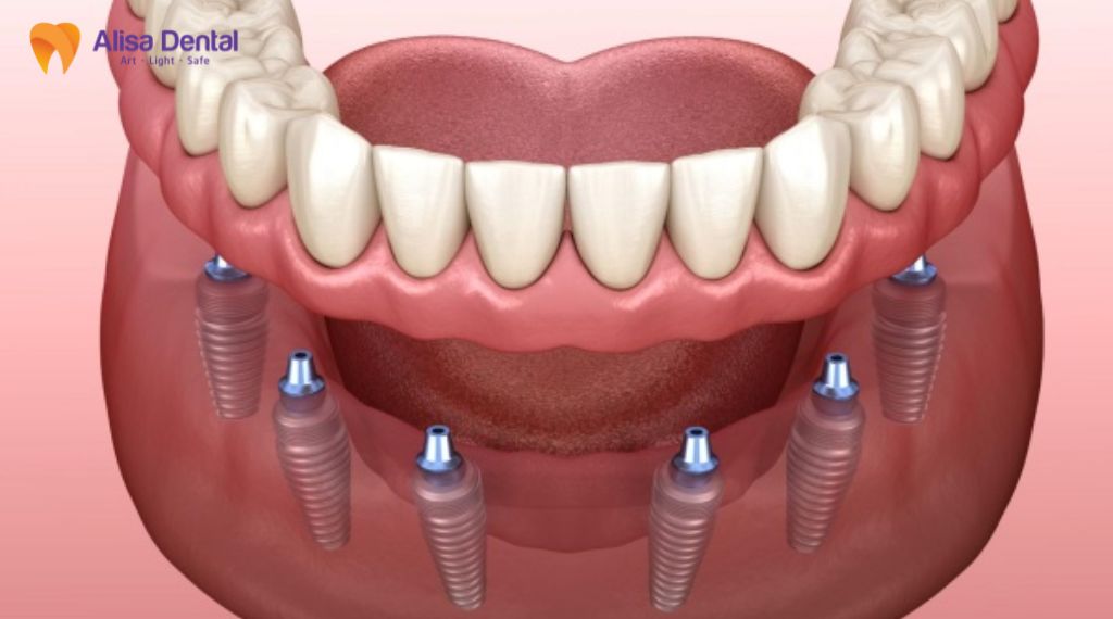 implant all on 4 Implant all on 6