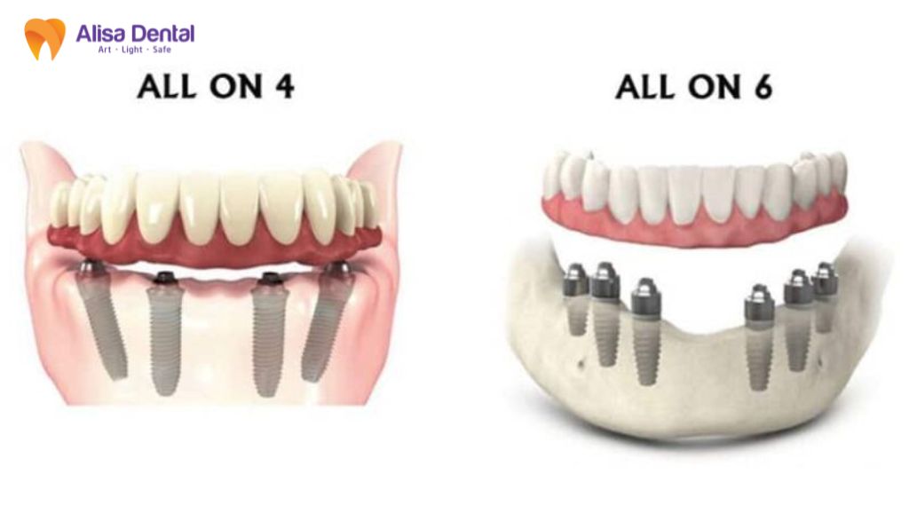 implant all on 4 Implant all on 6