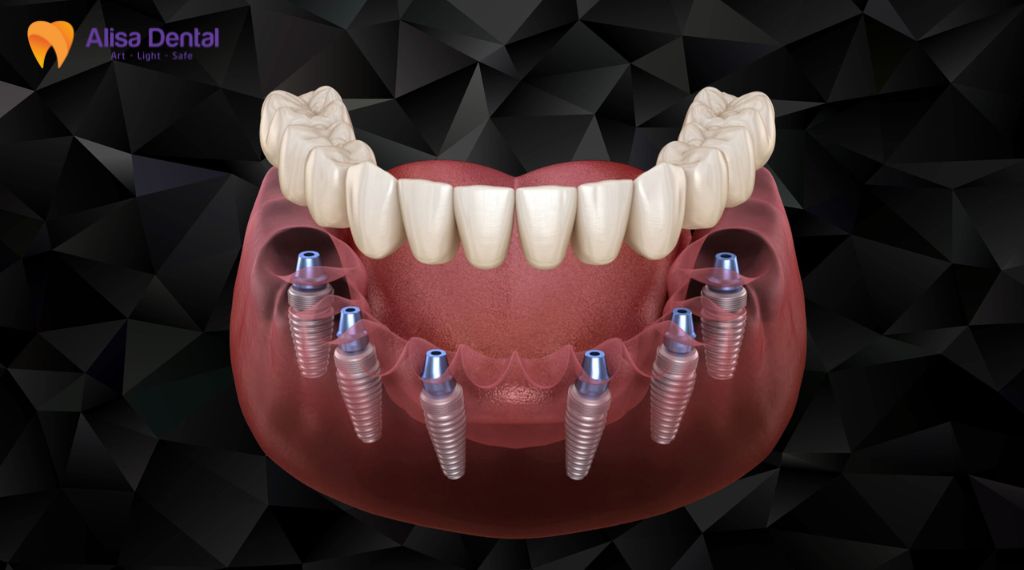 implant all on 4 Implant all on 6