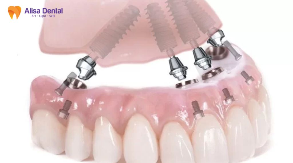 implant all on 4 Implant all on 6
