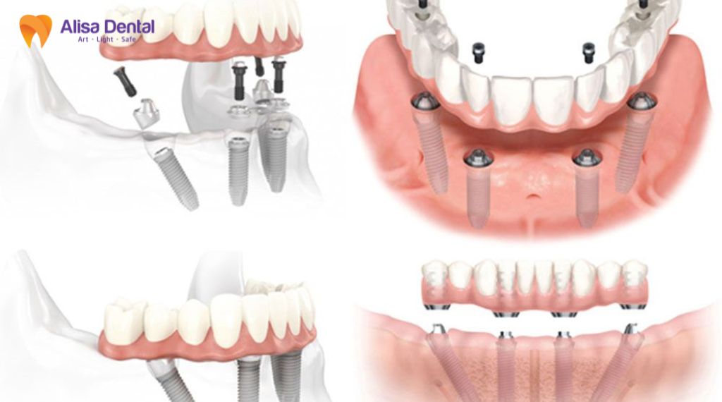 implant all on 4 Implant all on 6