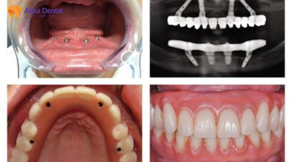 implant all on 4 Implant all on 6
