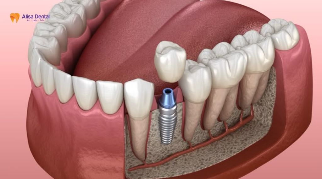 implant osstem