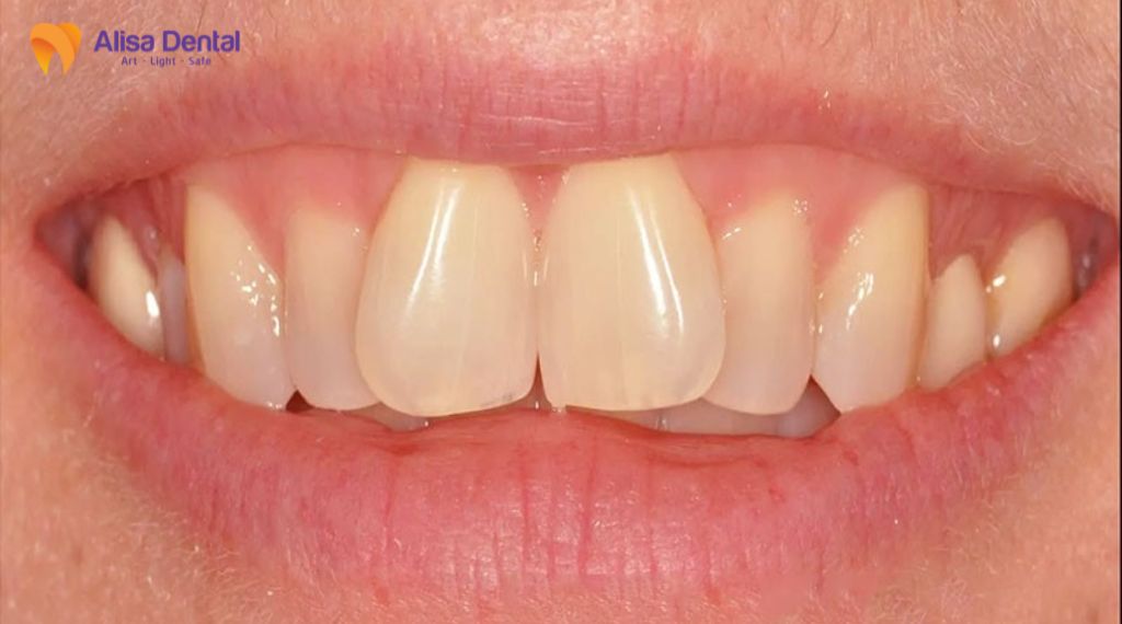 Răng cửa mọc lệch