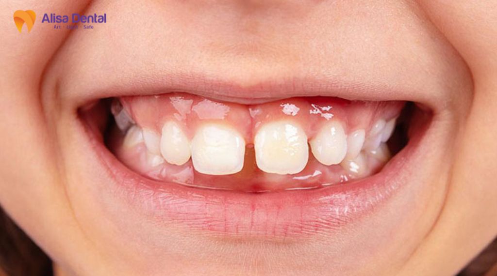 Răng cửa mọc lệch