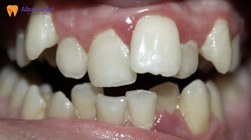 Răng cửa mọc lệch