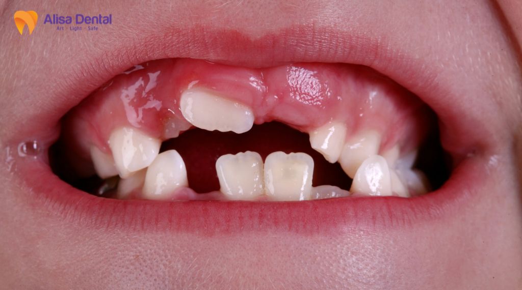 Răng cửa mọc lệch