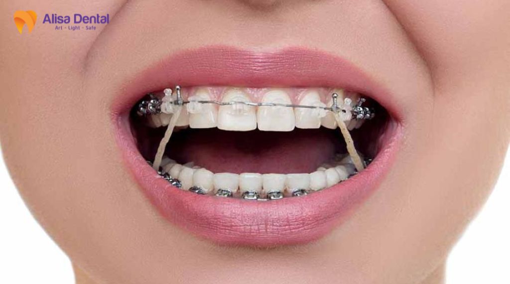 Răng cửa mọc lệch