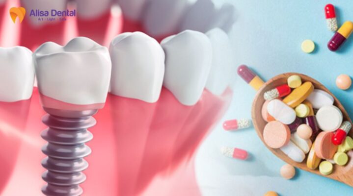 Sau khi cấy implant