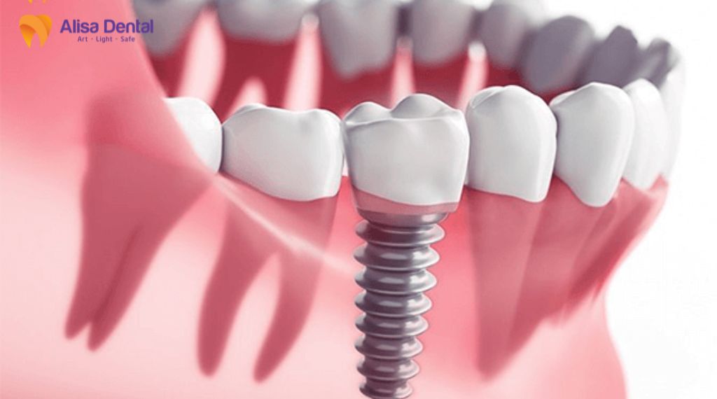 Sau khi cấy implant