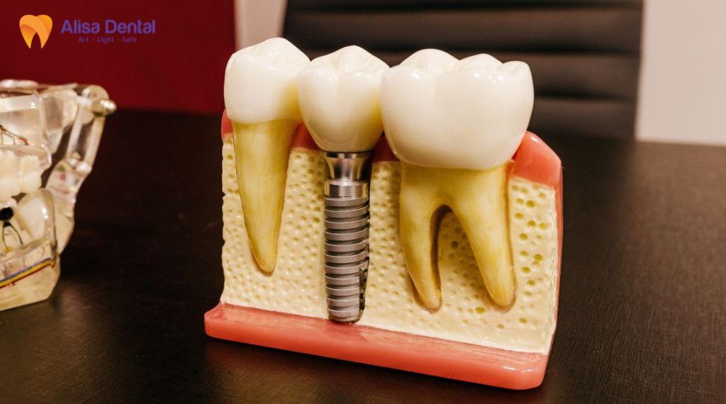 Trụ implant