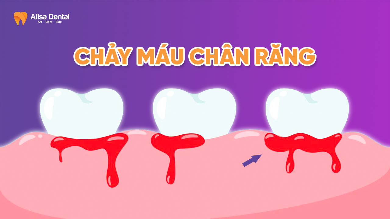 Chảy máu chân răng