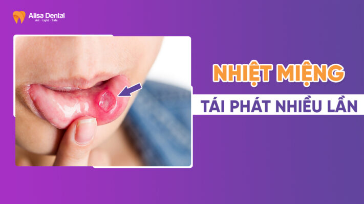 Nhiệt miệng tái phát nhiều lần