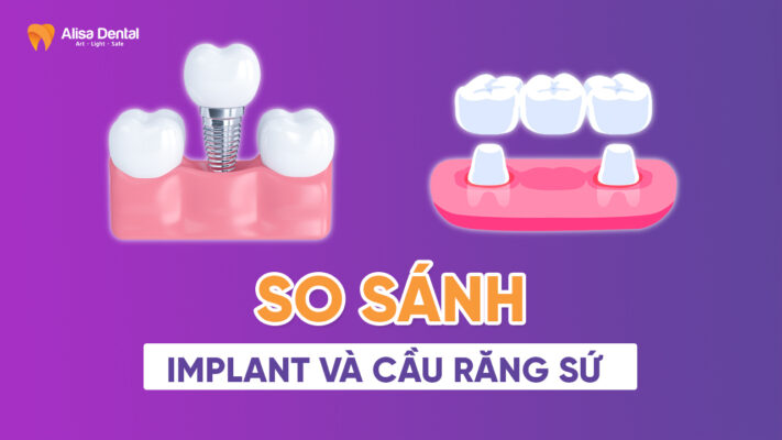 So sánh implant và cầu răng sứ