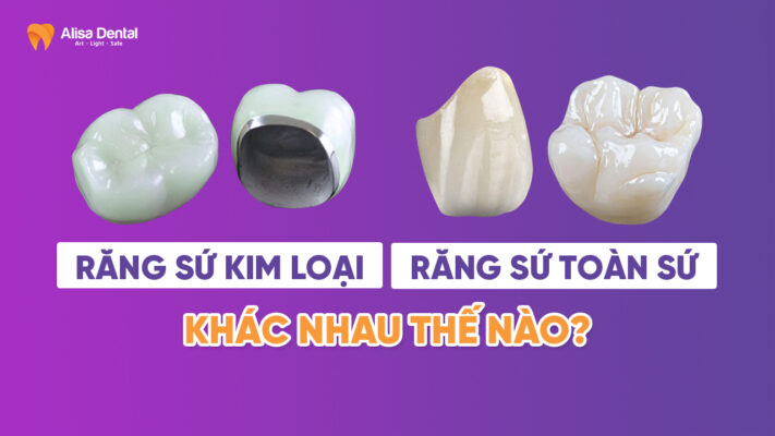 Răng sứ kim loại và răng sứ toàn sứ khác nhau thế nào