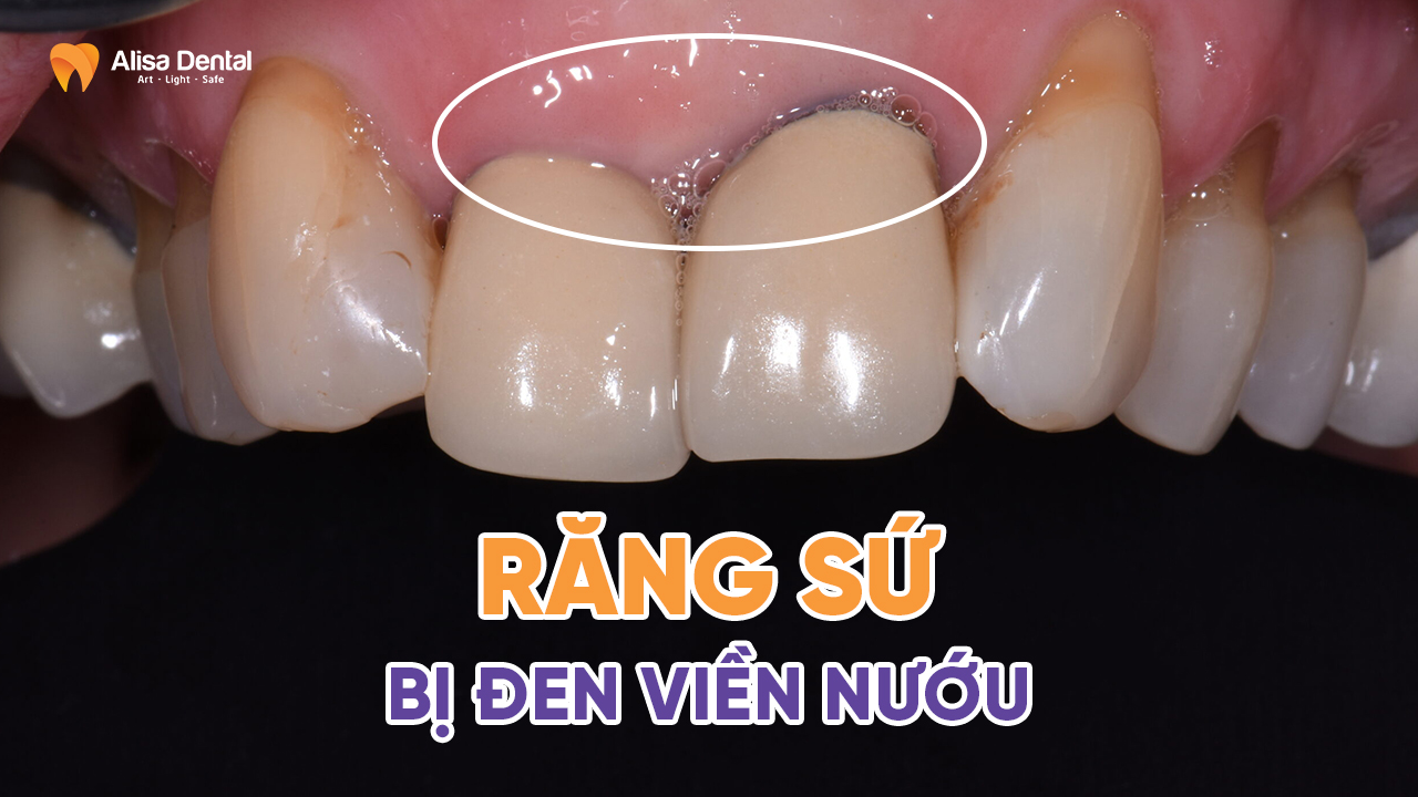 Răng sứ bị đen viền nướu