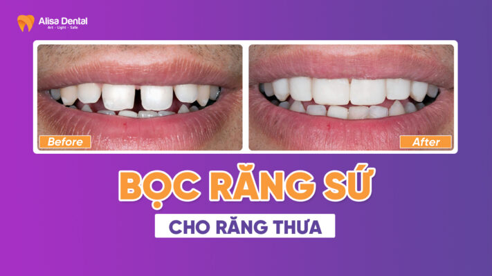 Bọc răng sứ cho răng thưa