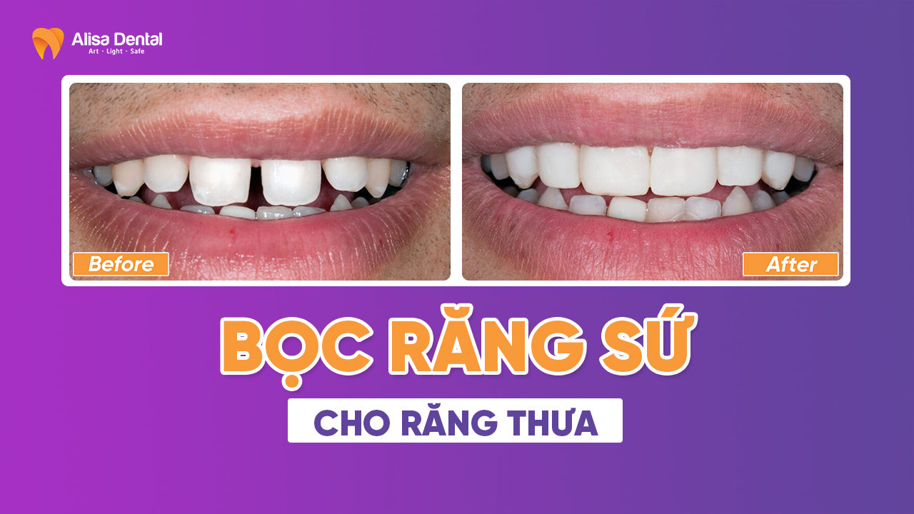 Bọc răng sứ cho răng thưa