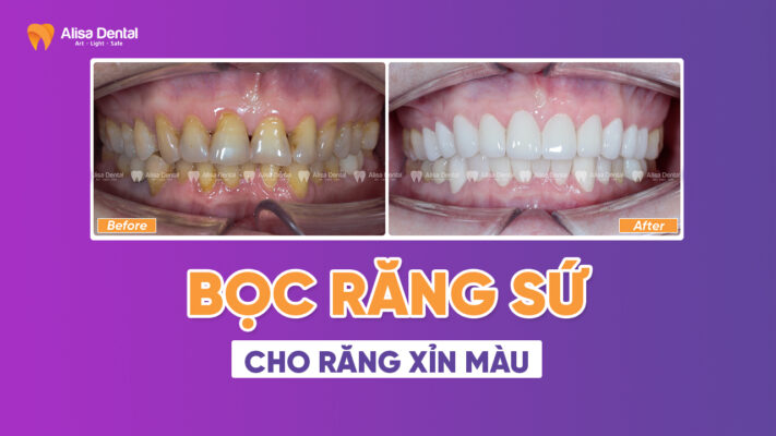 Bọc răng sứ cho răng xỉn màu