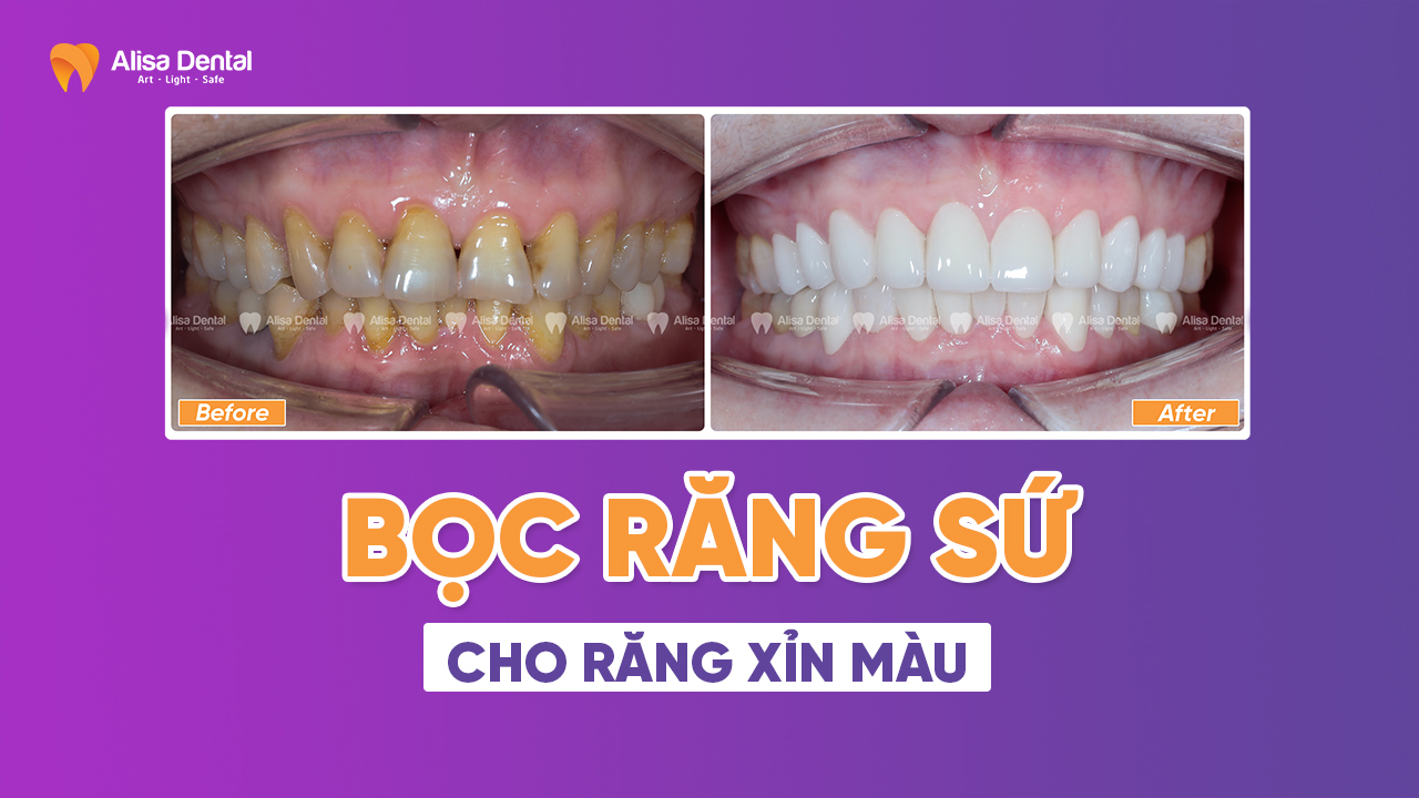 Bọc răng sứ cho răng xỉn màu