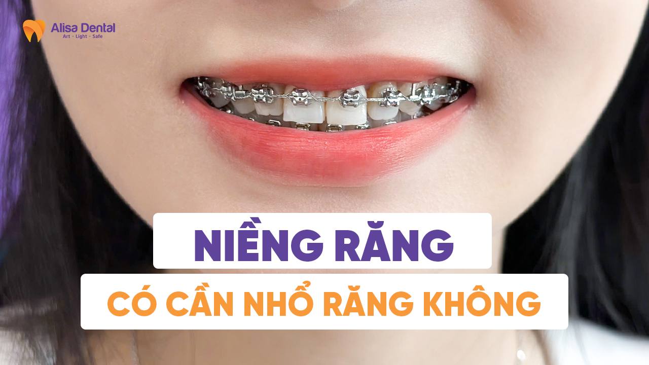 Niềng răng có cần nhổ răng không